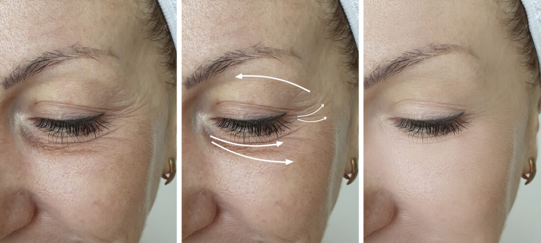 cómo usar la vitamina E para rejuvenecer el contorno de los ojos